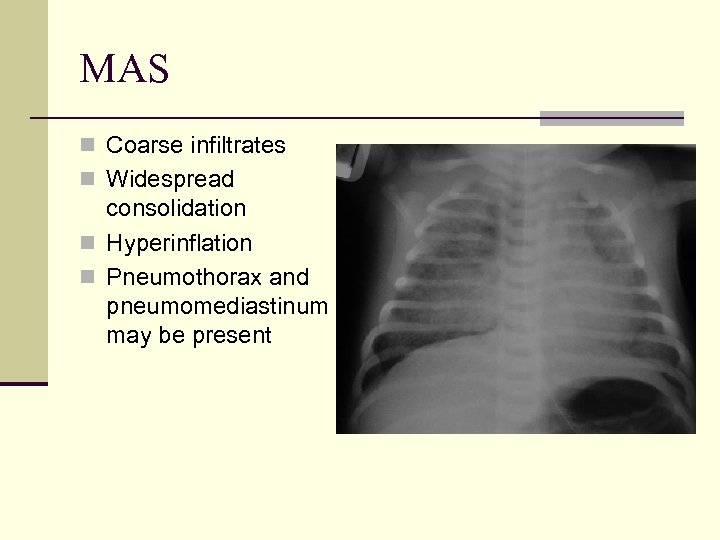 MAS n Coarse infiltrates n Widespread consolidation n Hyperinflation n Pneumothorax and pneumomediastinum may