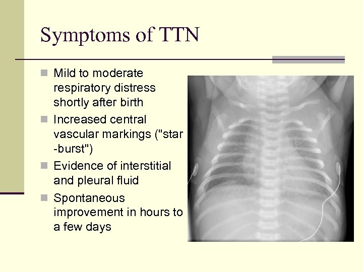 Symptoms of TTN n Mild to moderate respiratory distress shortly after birth n Increased