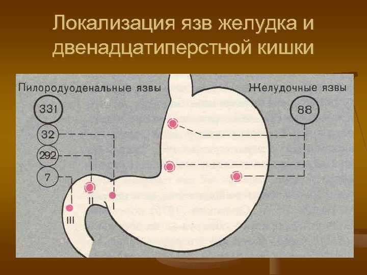 Локализация язв желудка и двенадцатиперстной кишки 