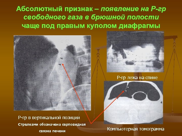 Абсолютный признак – появление на Р-гр свободного газа в брюшной полости чаще под правым