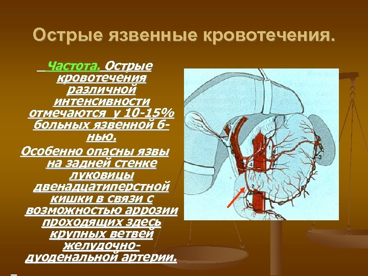 Острые язвенные кровотечения. Частота. Острые кровотечения различной интенсивности отмечаются у 10 -15% больных язвенной