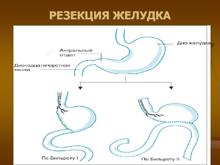 Резекция желудка картинки