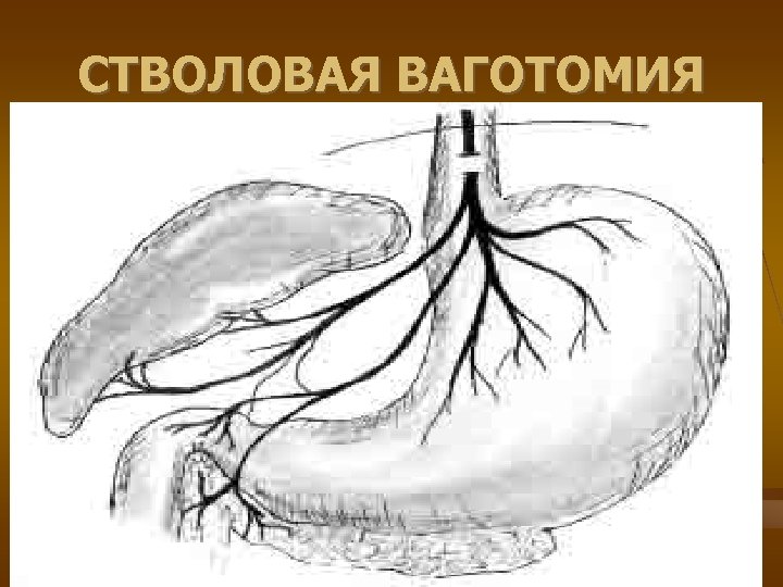 Осложнения язвенной болезни презентация факультетская хирургия