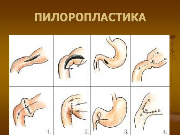 ПИЛОРОПЛАСТИКА 