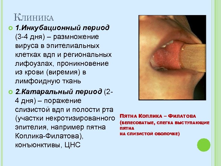 КЛИНИКА 1. Инкубационный период (3 -4 дня) – размножение вируса в эпителиальных клетках вдп
