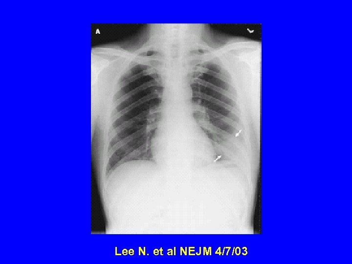 Lee N. et al NEJM 4/7/03 