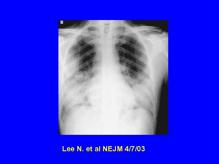 Lee N. et al NEJM 4/7/03 