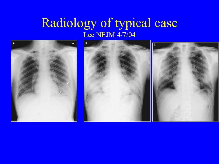 Radiology of typical case Lee NEJM 4/7/04 