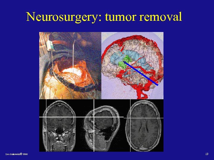 Neurosurgery: tumor removal Leo Joskowicz© 2000 13 