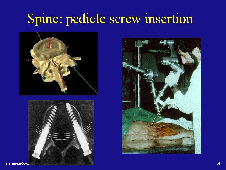 Spine: pedicle screw insertion Leo Joskowicz© 2000 14 