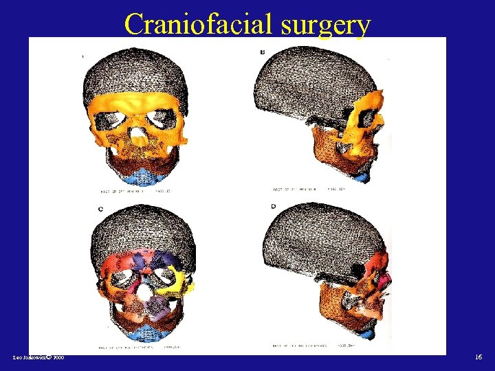 Craniofacial surgery Leo Joskowicz© 2000 16 