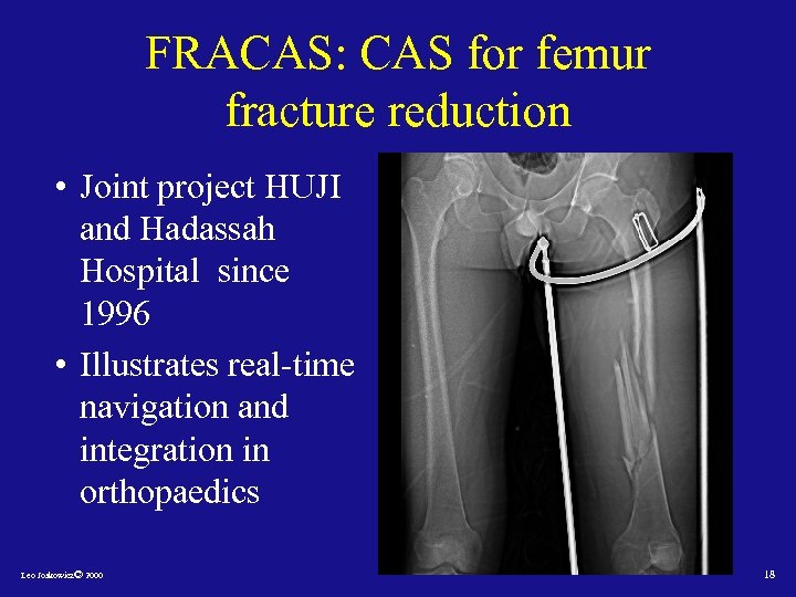 FRACAS: CAS for femur fracture reduction • Joint project HUJI and Hadassah Hospital since