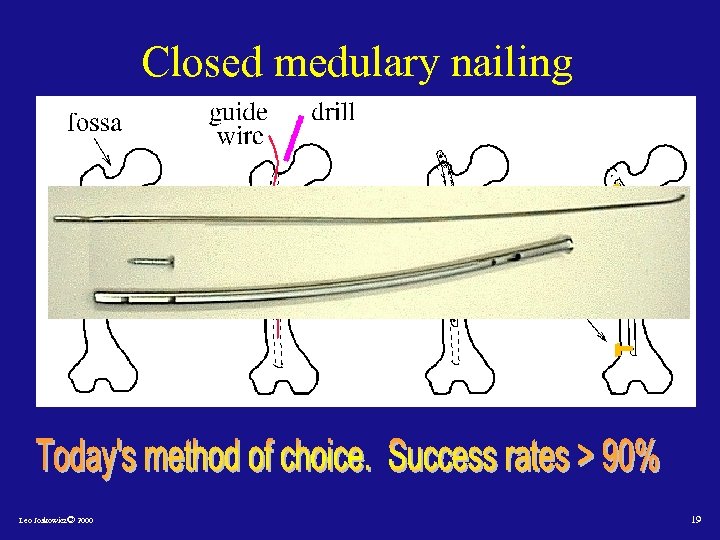 Closed medulary nailing Leo Joskowicz© 2000 19 