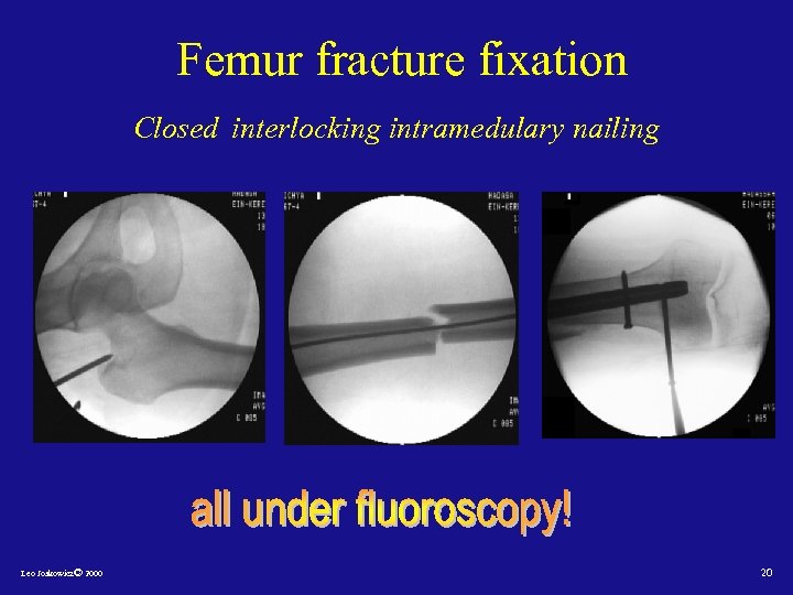 Femur fracture fixation Closed interlocking intramedulary nailing Leo Joskowicz© 2000 20 