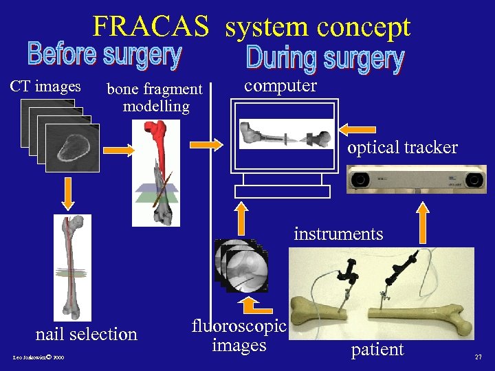 FRACAS system concept CT images bone fragment modelling computer optical tracker instruments nail selection