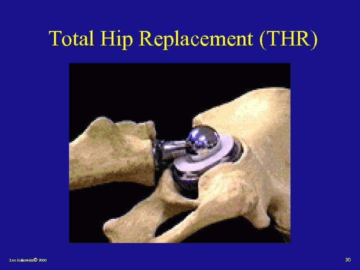 Total Hip Replacement (THR) Leo Joskowicz© 2000 30 