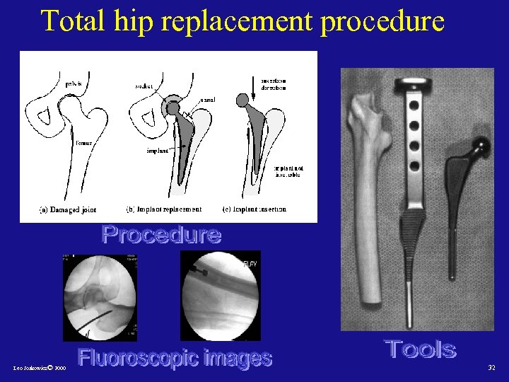 Total hip replacement procedure Leo Joskowicz© 2000 32 