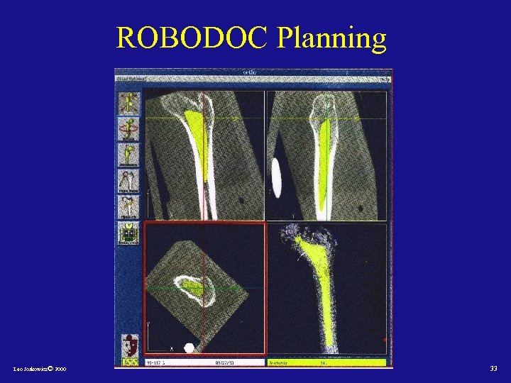 ROBODOC Planning Leo Joskowicz© 2000 33 