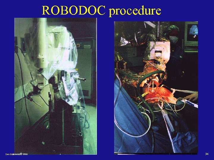 ROBODOC procedure Leo Joskowicz© 2000 34 