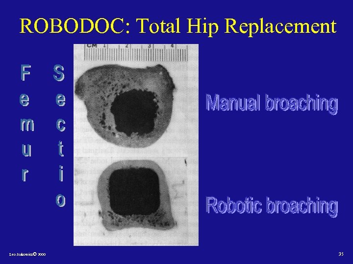 ROBODOC: Total Hip Replacement Leo Joskowicz© 2000 35 