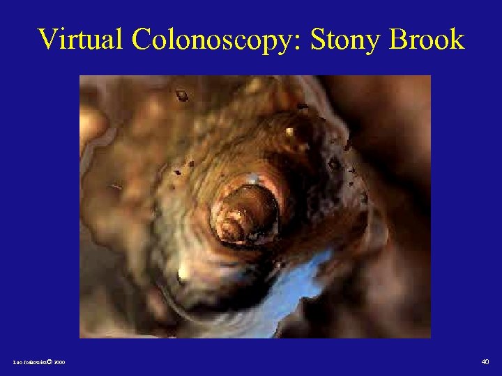 Virtual Colonoscopy: Stony Brook Leo Joskowicz© 2000 40 