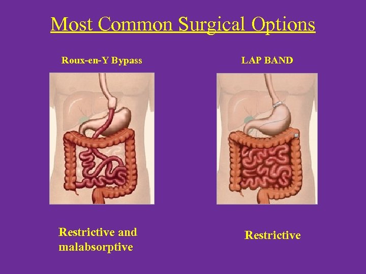 Most Common Surgical Options Roux-en-Y Bypass LAP BAND Restrictive and malabsorptive Restrictive 