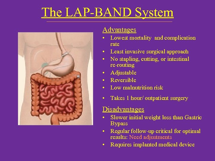 The LAP-BAND System Advantages • Lowest mortality and complication rate • Least invasive surgical