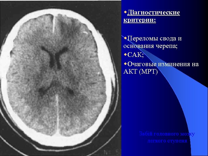 w. Діагностические критерии: w. Переломы свода и основания черепа; w. САК; w. Очаговые изминения