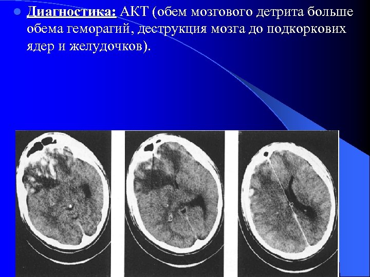 l Диагностика: АКТ (обем мозгового детрита больше обема геморагий, деструкция мозга до подкоркових ядер
