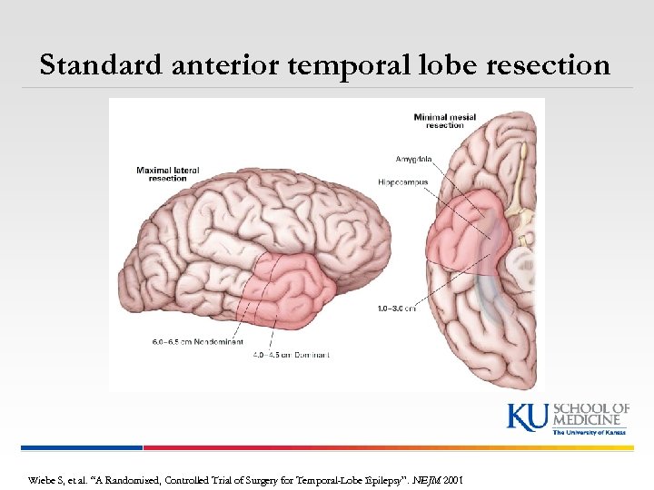 Standard anterior temporal lobe resection Wiebe S, et al. “A Randomized, Controlled Trial of