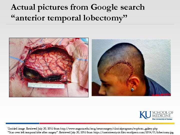 Actual pictures from Google search “anterior temporal lobectomy” Untitled image. Retrieved July 30, 2016