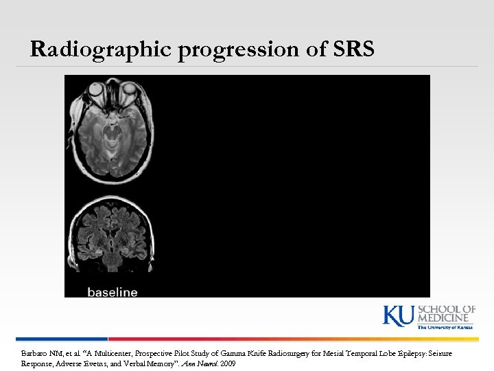 Radiographic progression of SRS Barbaro NM, et al. “A Multicenter, Prospective Pilot Study of