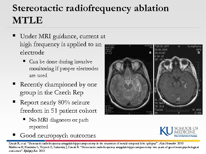 Stereotactic radiofrequency ablation MTLE § Under MRI guidance, current at high frequency is applied