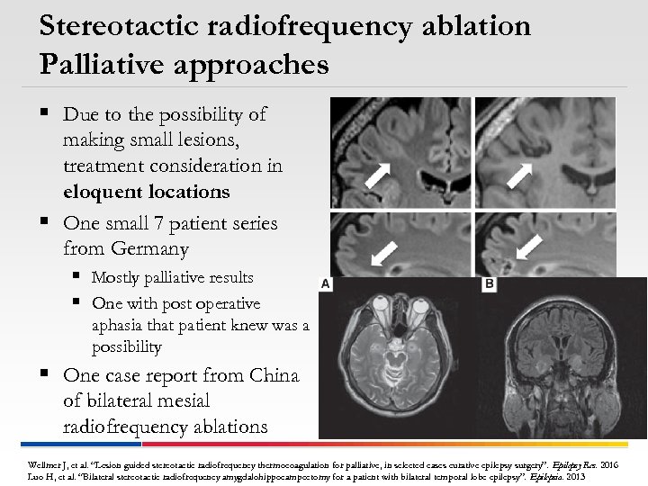 Stereotactic radiofrequency ablation Palliative approaches § Due to the possibility of making small lesions,