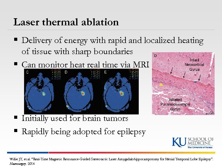Laser thermal ablation § Delivery of energy with rapid and localized heating of tissue