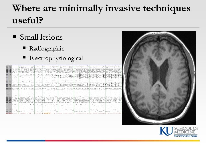 Where are minimally invasive techniques useful? § Small lesions § Radiographic § Electrophysiological §