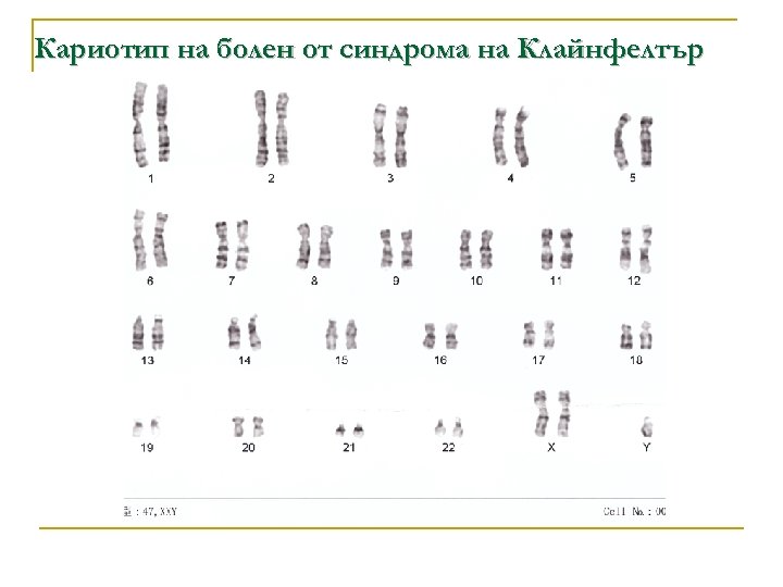 Кариотип на болен от синдрома на Клайнфелтър 