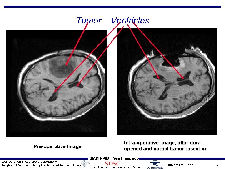 Tumor Pre-operative Image Computational Radiology Laboratory Brigham & Women’s Hospital, Harvard Medical School Ventricles