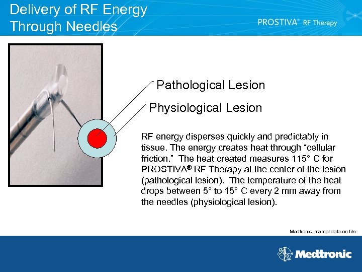 Delivery of RF Energy Through Needles Pathological Lesion Physiological Lesion RF energy disperses quickly