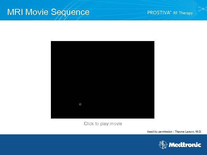 MRI Movie Sequence Click to play movie Used by permission - Thayne Larson, M.