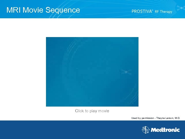 MRI Movie Sequence Click to play movie Used by permission - Thayne Larson, M.