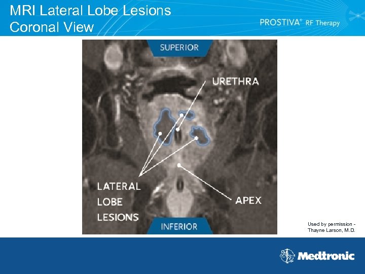 MRI Lateral Lobe Lesions Coronal View Used by permission Thayne Larson, M. D. 