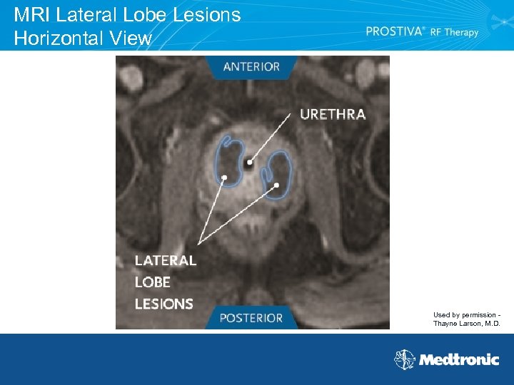 MRI Lateral Lobe Lesions Horizontal View Used by permission Thayne Larson, M. D. 