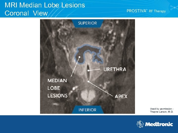 MRI Median Lobe Lesions Coronal View Used by permission Thayne Larson, M. D. 