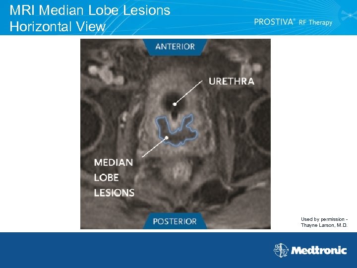 MRI Median Lobe Lesions Horizontal View Used by permission Thayne Larson, M. D. 