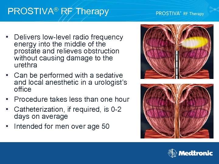 PROSTIVA® RF Therapy • Delivers low-level radio frequency energy into the middle of the