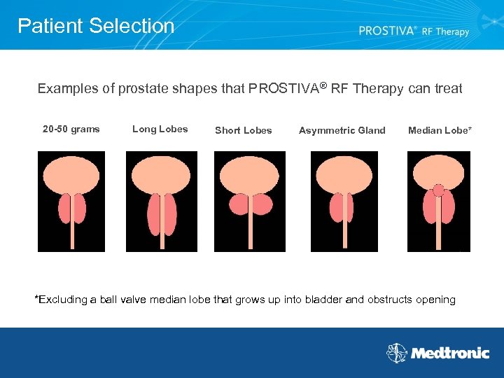 Patient Selection Examples of prostate shapes that PROSTIVA® RF Therapy can treat 20 -50