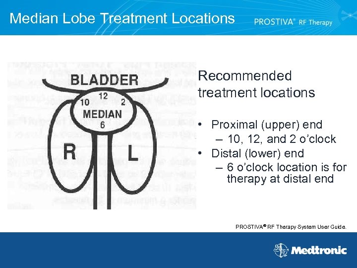 Median Lobe Treatment Locations Recommended treatment locations • Proximal (upper) end – 10, 12,