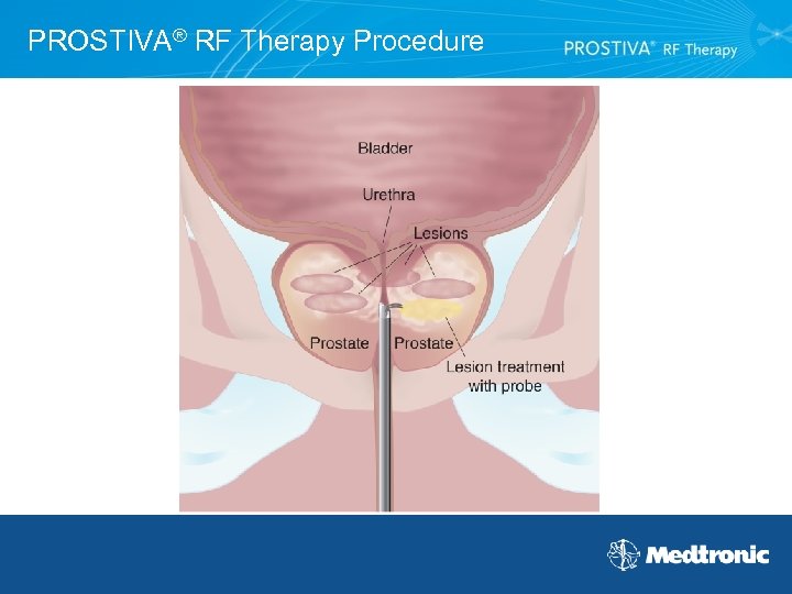 PROSTIVA® RF Therapy Procedure 