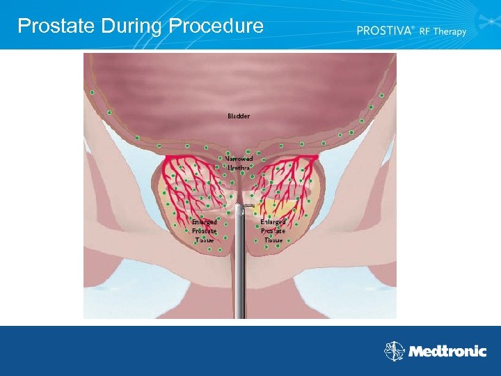 Prostate During Procedure 